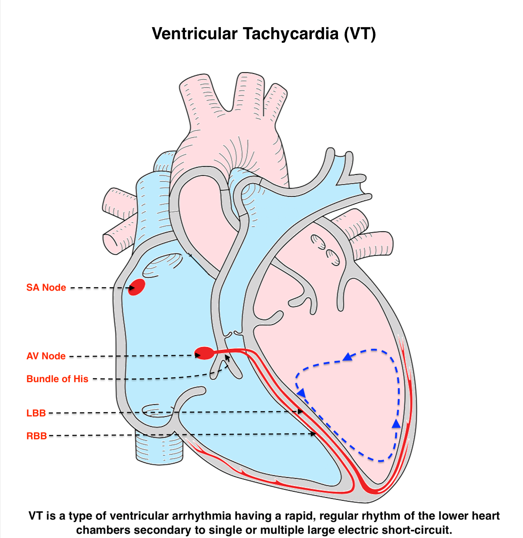 Ventricular Tachycardia (VT)