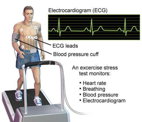 Exercise Stress Test (Treadmill test = TMT)