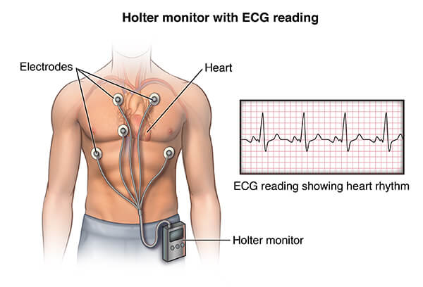 Holter monitor