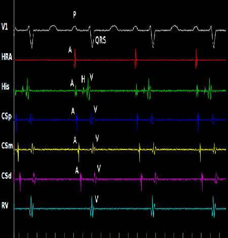 Electrophysiology Study