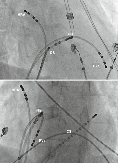 2D RF ablation