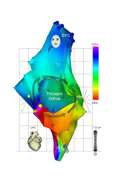 3D Mapping & RF Ablation