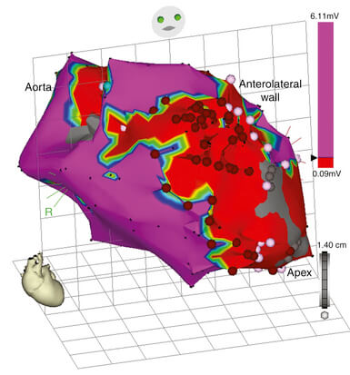 3D mapping & Catheter Ablation (3D RF ablation)